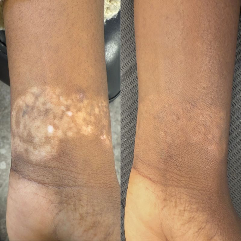 Ärrkamouflage, före och efter behandling av hypopigmentering på arm