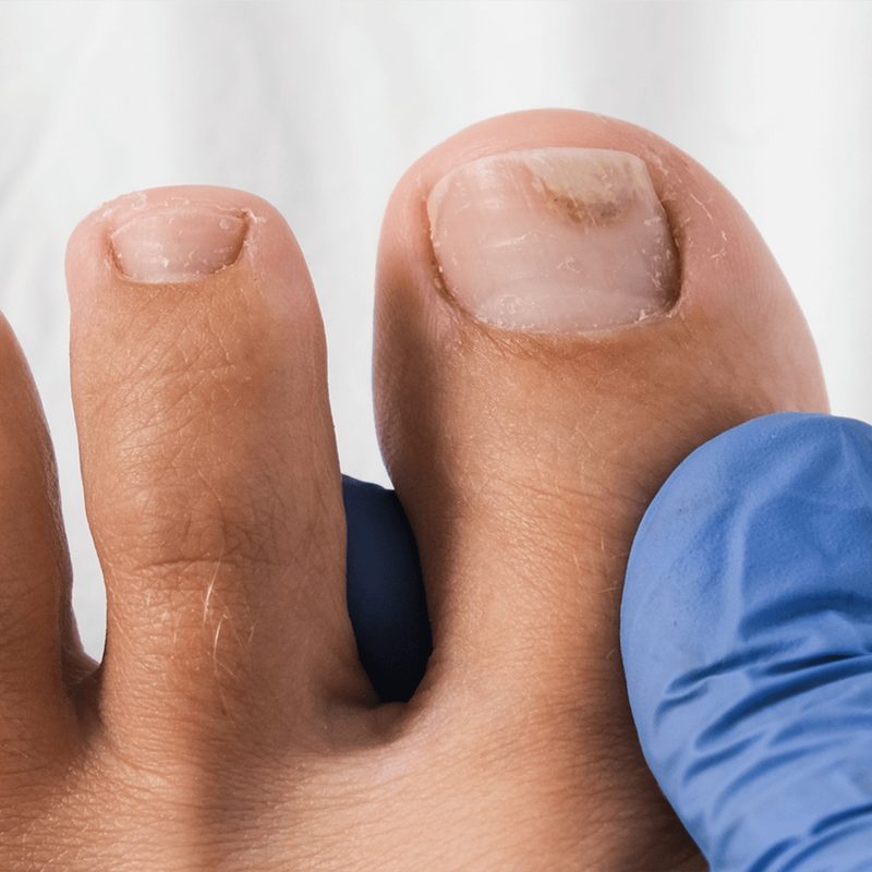 Nagelsvampbehandling med laser