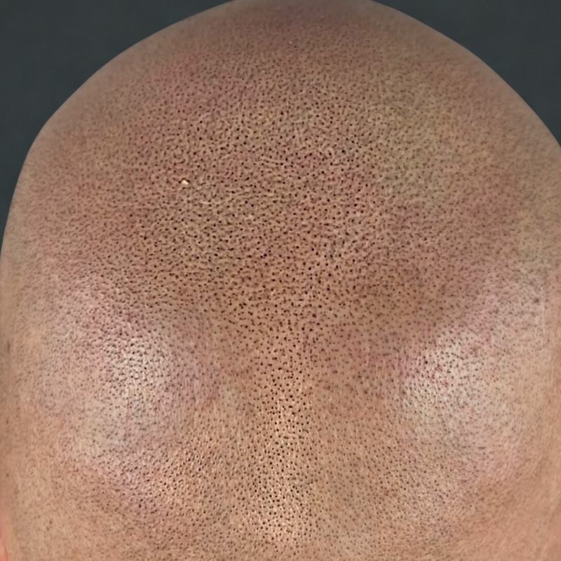Scalp micropigmentation, närbild på hjässa efter behandling